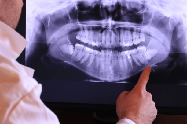 Best Knocked-Out Tooth (Avulsed Tooth) Treatment in Dadeville, AL